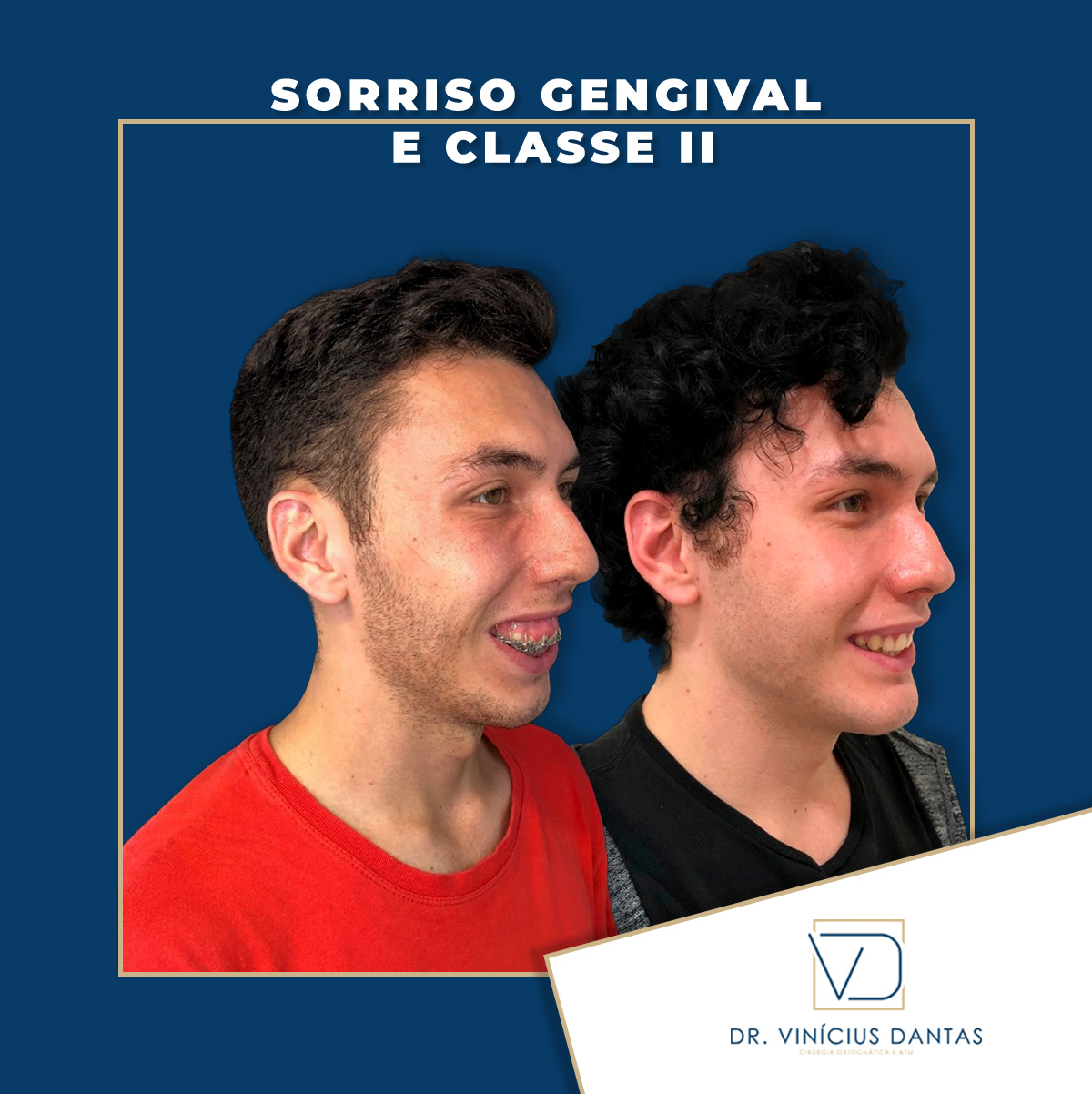 Sorriso gengival