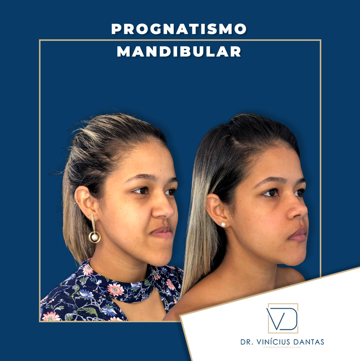 Queixo para frente